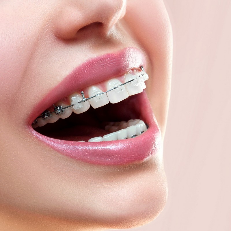 uploads/file/icon-2019-02-26-094916-gio-orthodontics-and-invisalign.jpg