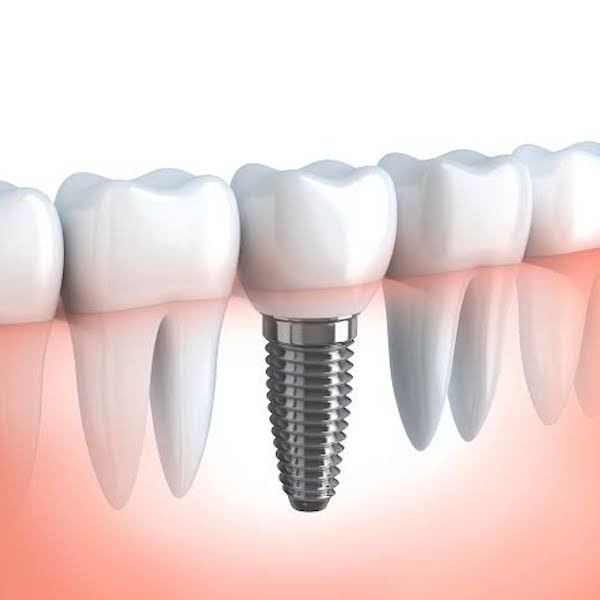 uploads/file/icon-2020-11-16-181406-gio-dental-implants.jpeg
