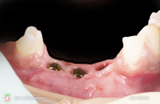 gio-ceramic-crown-bridge-and-implant