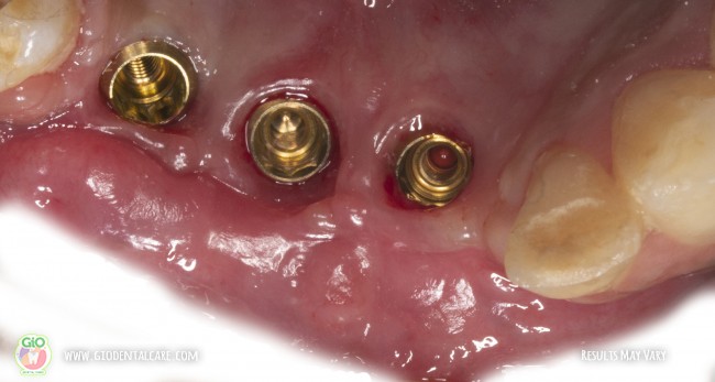 gio-ceramic-crown-bridge-and-implant