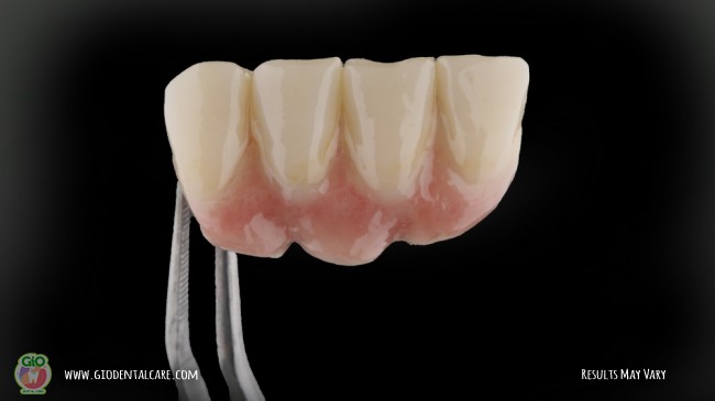 gio-ceramic-crown-bridge-and-implant