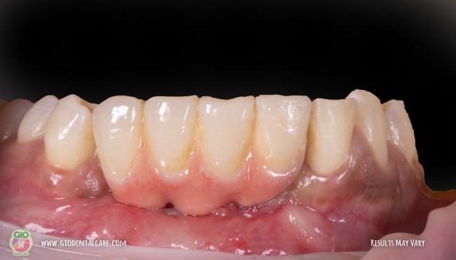gio-ceramic-crown-bridge-and-implant