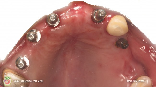 gio-dental-implants-1