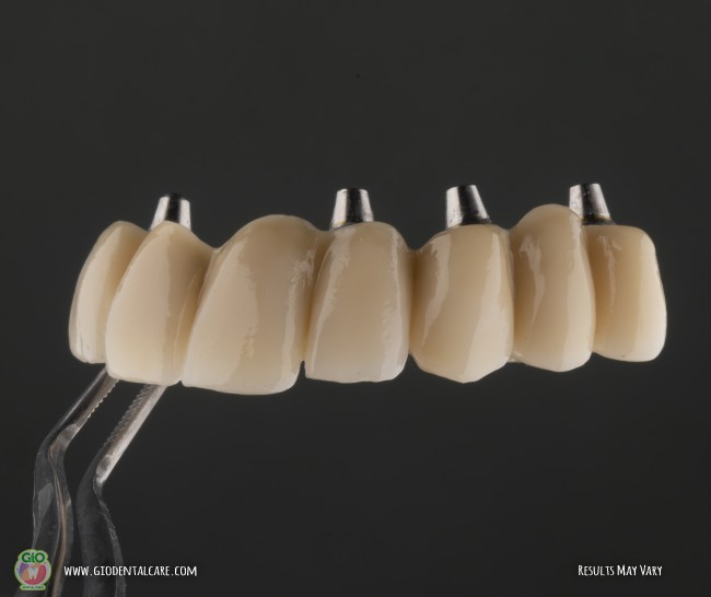 gio-dental-implants-1