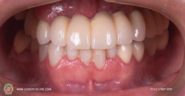 gio-dental-implants-1