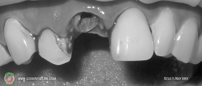 gio-dental-implants-1