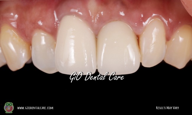 gio-dental-implants-1