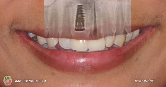gio-dental-implants-1