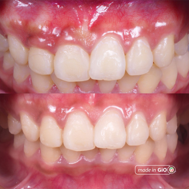 gio-gingivectomy