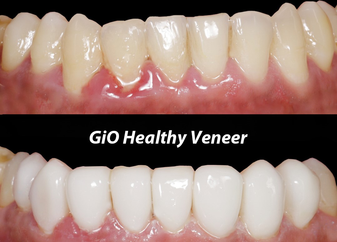 gio-healthy-veneer