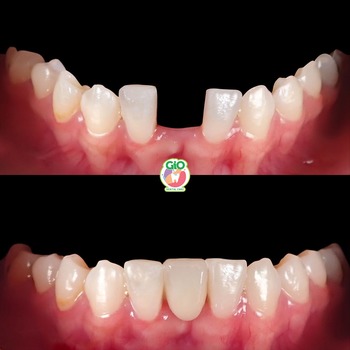 GiO Dental Implant