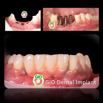 GiO Dental Implant
