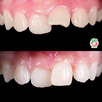 GiO Healthy Veneer