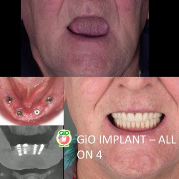 GiO Dental Implant